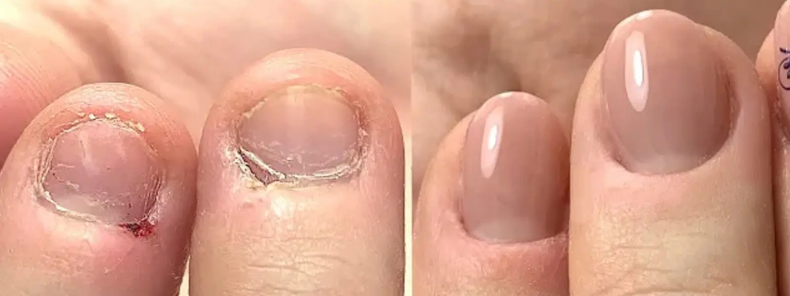 jealis_academy_cursus_nagelbijters_b