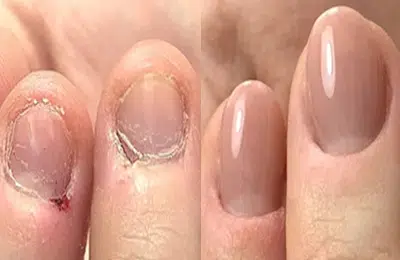 jealis_academy_cursus_nagelbijters_o